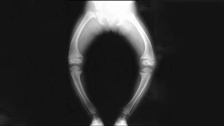 O que é osteomalácia?