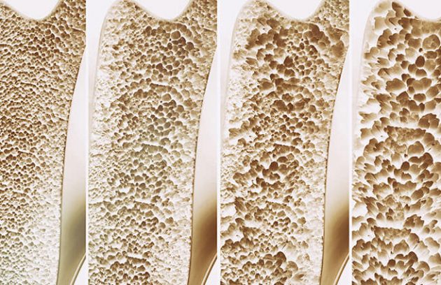 O que é osteoporose?