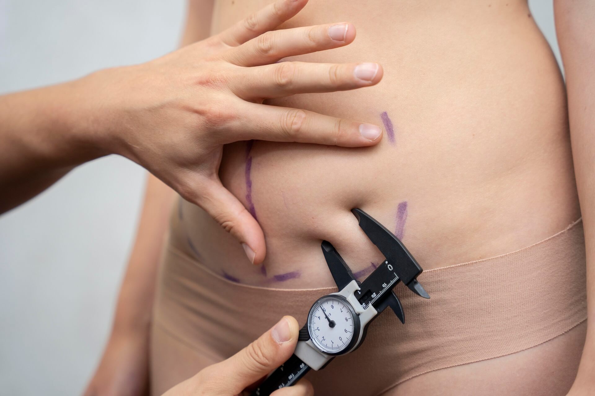 Cirurgia reparadora pós-bariátrica: opcional ou obrigatória? - Clinica Croce
